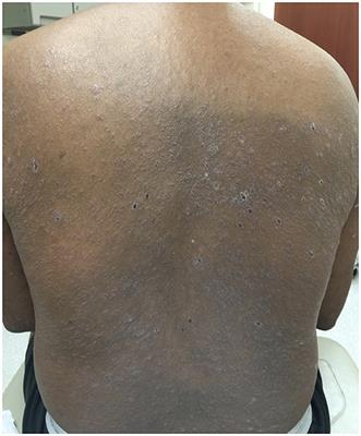 Management of Persistent Pruritus and Lichenoid Reaction Secondary to Nivolumab With Narrowband Ultraviolet B Phototherapy